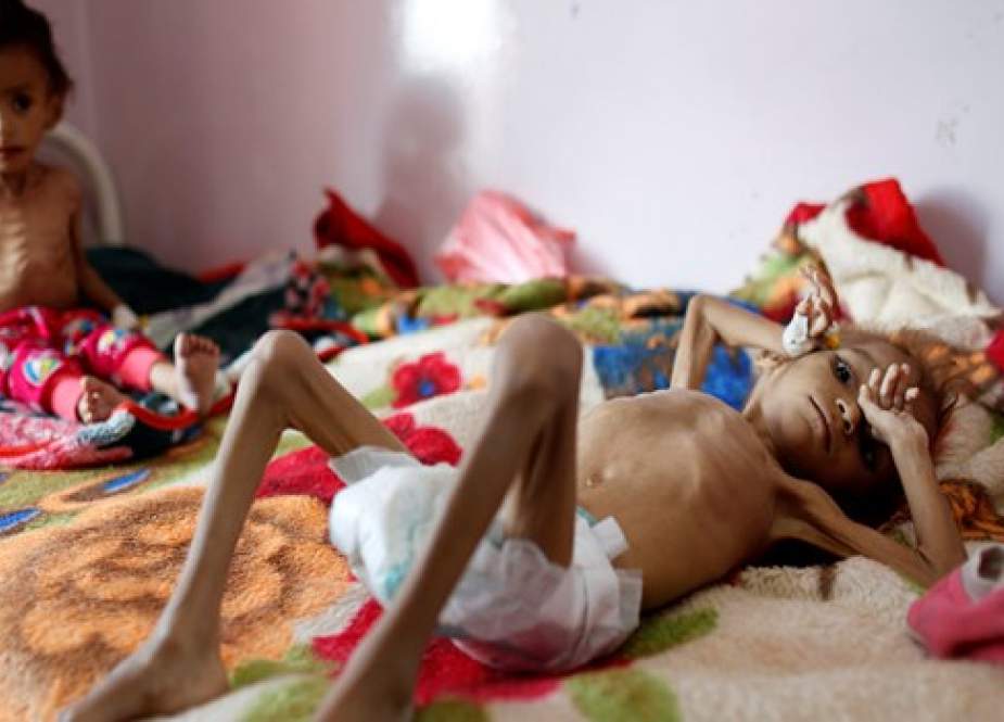 أمل اليمنية التي أبكت صورتها العالم تموت من الجوع والمرض
