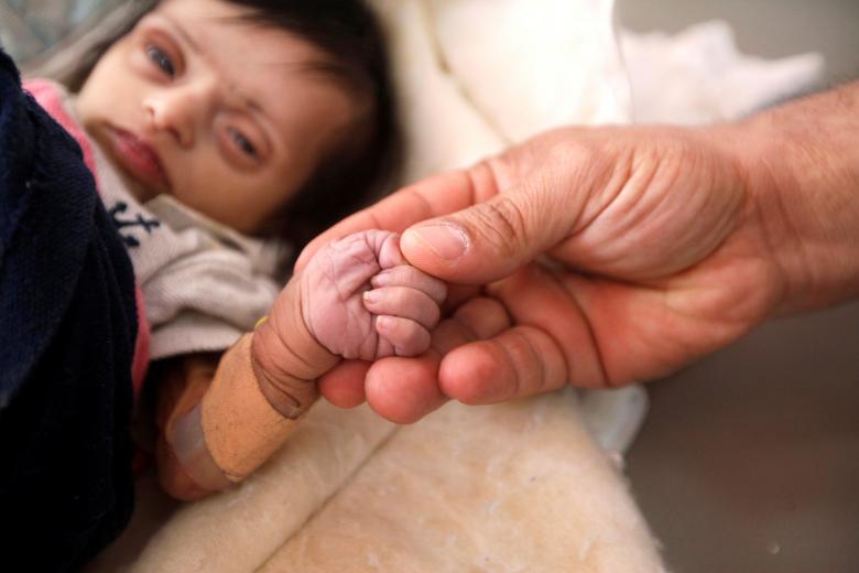 A nurse holds the hand of malnourished 2-month-old Jood Motaher two days before her death at a malnutrition treatment center in Sanaa, Yemen November 22, 2018. A survey of food security in Yemen has found more than 15 million people are in a 