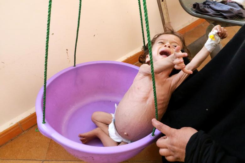 Malnourished Zakaria Yahya, 21 months old, is weighed in a hospital in the northwestern city of Saada, November 21, 2018. The survey, carried out by Yemeni and international experts in October according to an international system for classifying food cri
