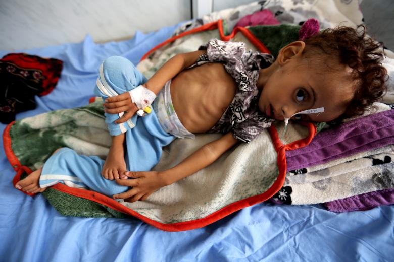 Malnourished 1-year-old Abdulqudous Hadi lies on a bed at a malnutrition treatment ward at al-Thawra hospital in Hodeidah, November 3, 2018.