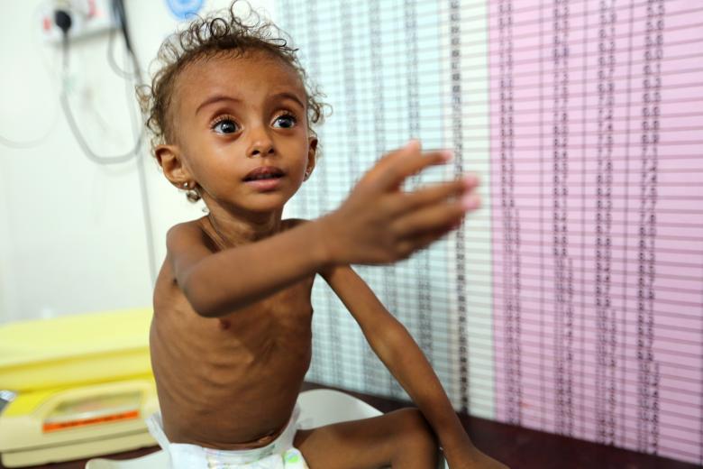 Malnourished Ferial Elias, 2, gestures as she is being weighed at a malnutrition treatment ward at al-Thawra hospital in Hodeidah, November 3, 2018.