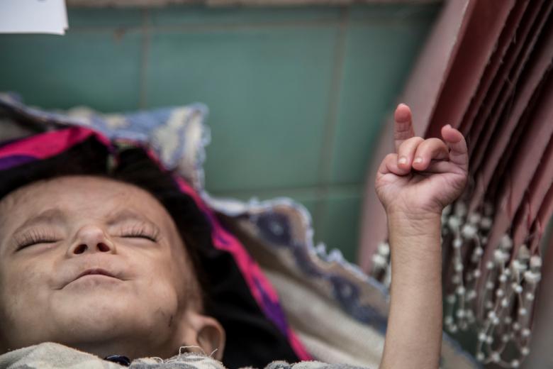 Ali Yakya Ali, 5, suffering from severe acute malnutrition edematous, which causes an excessive amount of water fluid in the tissues, is seen in Saana, November 11, 2018.