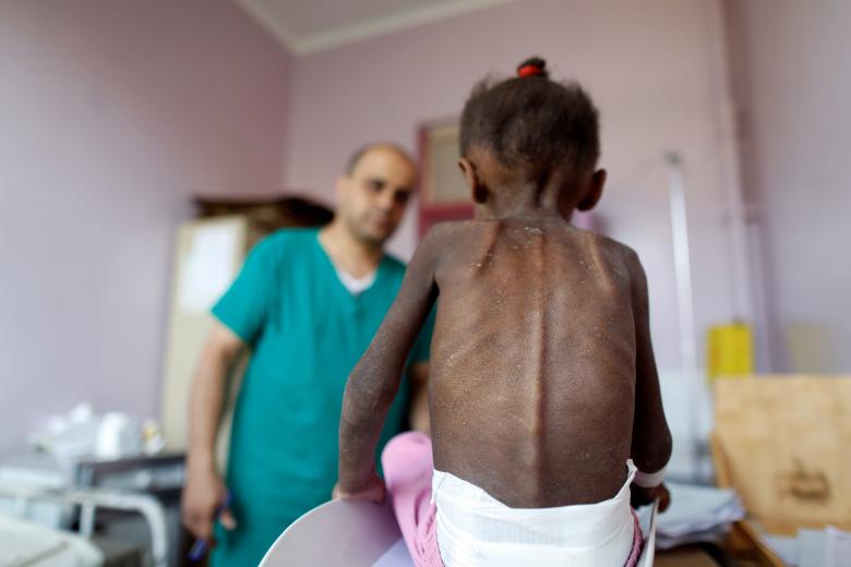 A nurse looks as he weighs a malnourished girl at a malnutrition treatment center in Sanaa, October 7, 2018.