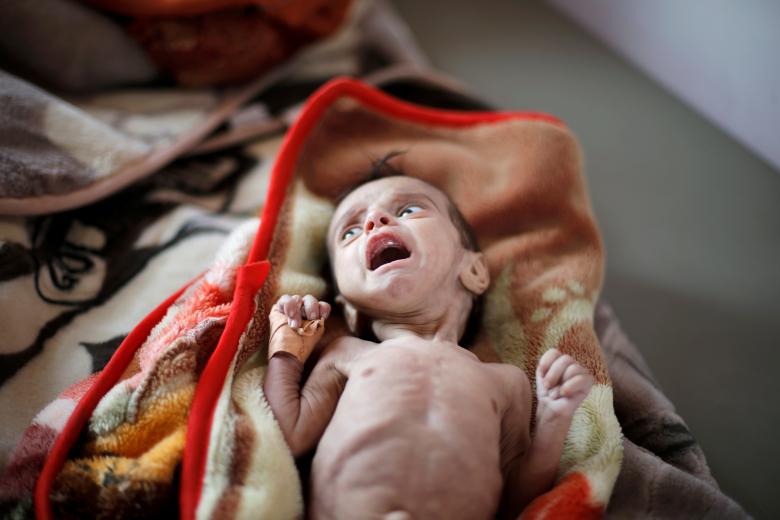 A malnourished boy lies on a bed at the malnutrition ward of al-Sabeen hospital in Sanaa, September 11, 2018.