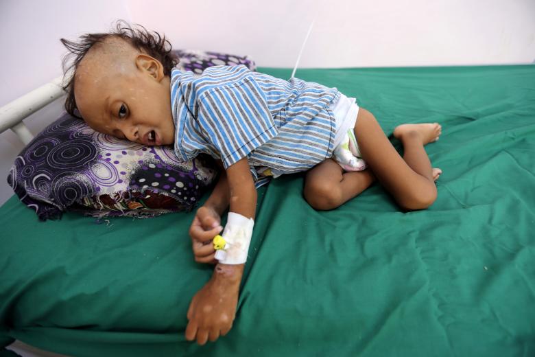 Jibril Mohammed Ali Al-Hakami, 2, lies on a bed at the al-Thawra hospital where he receives treatment for malnutrition in Hodeidah, November 17, 2018.