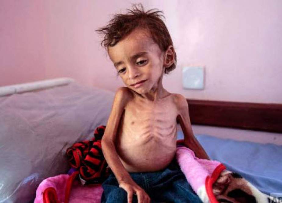 چهارصد هزار کودک زیر ۵ سال یمنی در آستانه مرگ از گرسنگی