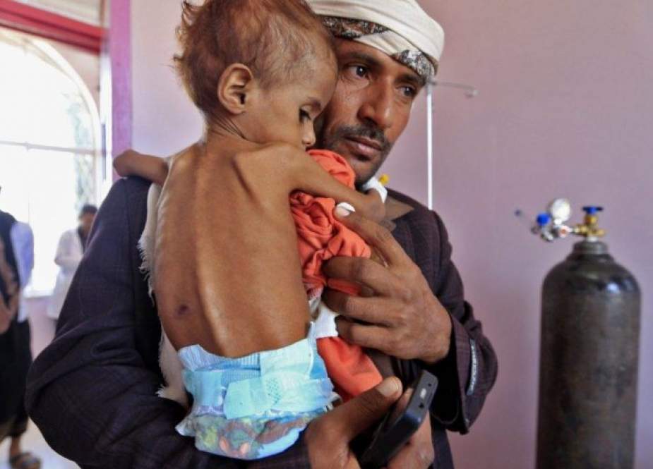 العدوان والحصار سبب رئيسي لسوء التغذية الحاد باليمن